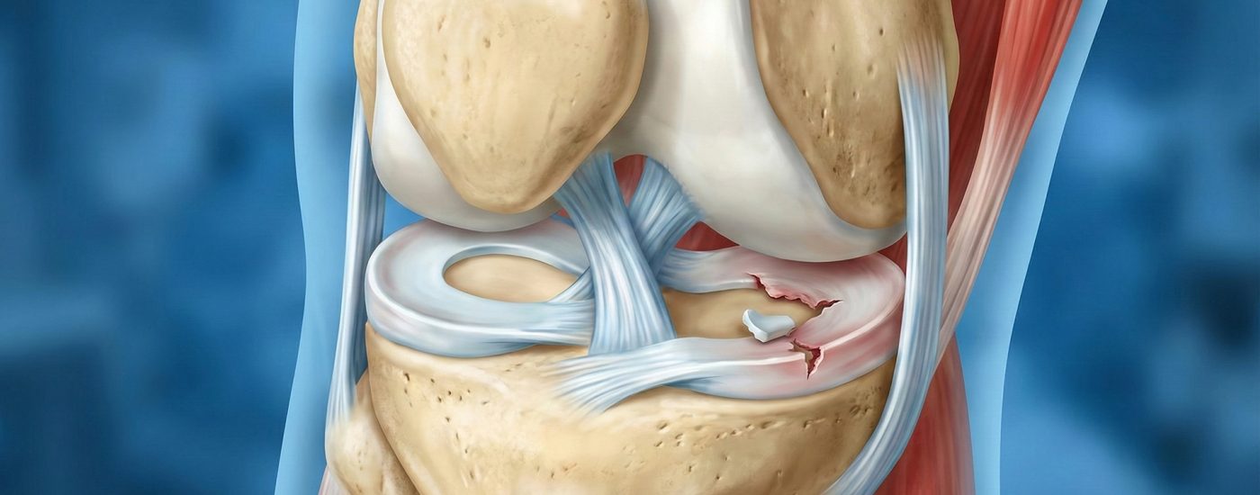 meniskus-yirtigi meniskus-yirtigi